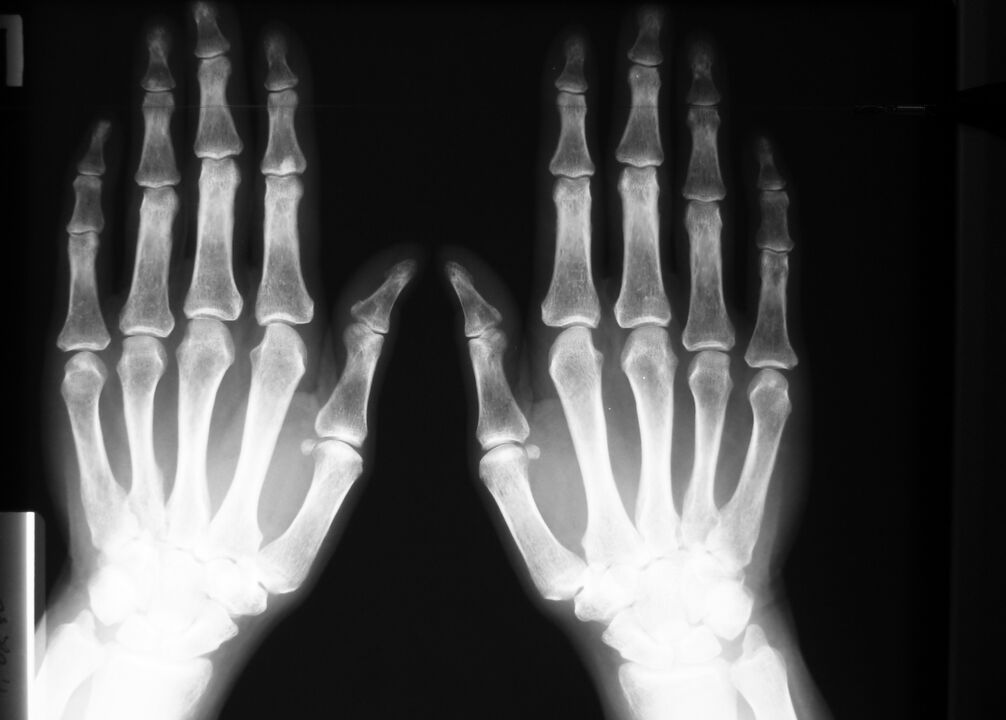 rentgeno spinduliai, skirti diagnozuoti pirštų sąnarių skausmą