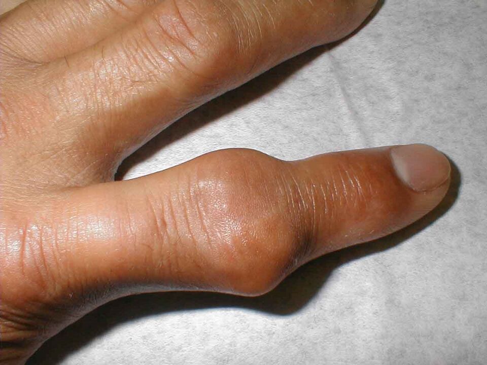 tophi piršto sąnaryje kaip skausmo priežastis